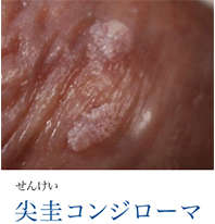 せんけい 尖圭コンジローマ
