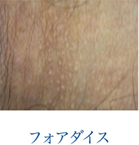 フォアダイス