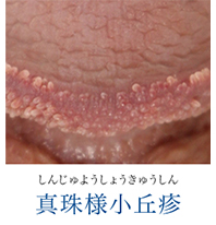 しんじゅようしょうきゅうしん 真珠様小丘疹