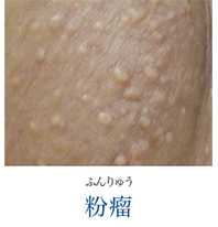 ふんりゅう 粉瘤