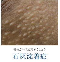 せっかいちんちゃくしょう 石沈着症