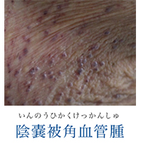 いんのうひかくけっかんしゅ 陰嚢被角血管腫