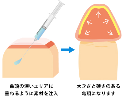 亀頭の深いエリアに重ねるように素材を注入大きさと硬さのある亀頭になります