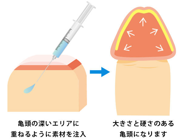 亀頭の深いエリアに重ねるように素材を注入大きさと硬さのある亀頭になります