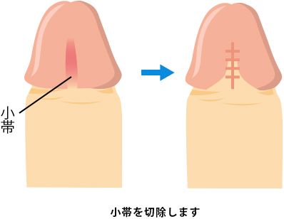 小帯小帯を切除します