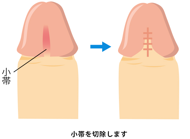 小帯小帯を切除します