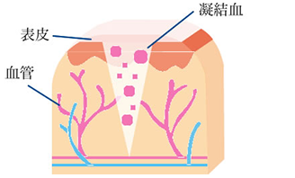表皮血管凝結血