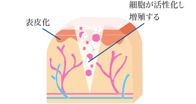 表皮化細胞が活性化し増殖する