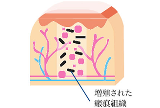 増殖された瘢痕組織