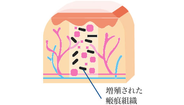増殖された瘢痕組織