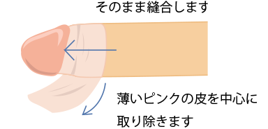 そのまま縫合します薄いピンクの皮を中心に取り除きます