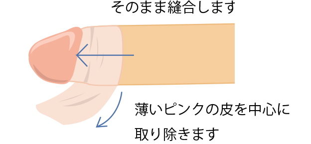 そのまま縫合します薄いピンクの皮を中心に取り除きます