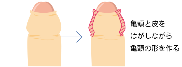 亀頭と皮をはがしながら亀頭の形を作る