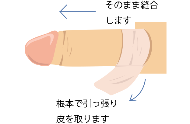 そのまま縫合します。根本で引っ張り皮を取ります