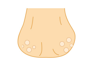 粉瘤